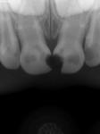 Кариес передних зубов фото 1