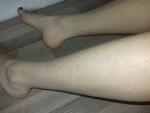 Пятна на коже ног фото 3