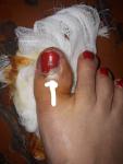 Травма большого пальца ноги фото 1