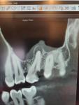 Лечение или удаление зуба-восьмёрки? фото 1
