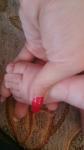 Нарост впритык к ногтям больших пальцев на ногах ребенка фото 2