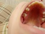 Нарост десны между зубами фото 2