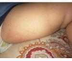 Сыпь на ногах у ребенка фото 1