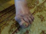 Почернение кожи пальцев на стопе и распухание стопы фото 1