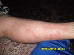 Лекарственная аллергия при лечении гепатита с фото 2