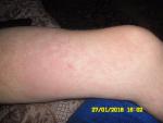 Лекарственная аллергия при лечении гепатита с фото 1