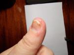 Водяные пузырьки около ногтя и под ногтем пальцев рук фото 5