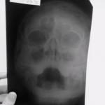 Рентген носовых пазух фото 1