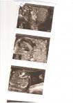 Узи сердца плода 18-19 недель беременности, впс, дмпп, дмжп фото 2