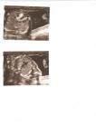 Узи сердца плода 18-19 недель беременности, впс, дмпп, дмжп фото 3