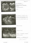 Диагноз по узи: признаки хронического эндометрита и эндоцервикоза, фото 2