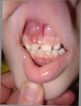 Появилась шишка над зубом у ребенка фото 1