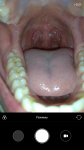 Острая боль в глубине горла, боль в мышцах рта фото 2