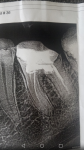 Болит леченый зуб фото 1