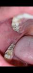 Рак слизистой рта или нет фото 4