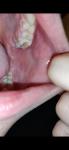 Рак слизистой рта или нет фото 3