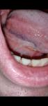 Рак слизистой рта или нет фото 2