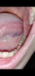 Рак слизистой рта или нет фото 1