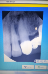 Ноет здоровый зуб, воспаление на корне фото 1