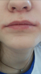Покраснение кожи вокруг губы и заеды фото 2