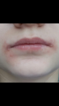 Покраснение кожи вокруг губы и заеды фото 3