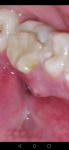 На лесне шишка у зуба и посередине что то белое фото 2