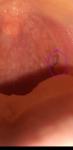 Белое плоское пятно на горле, лимфоузлы фото 1