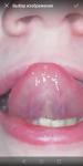 Прозрачное воспаление на кончике языка фото 1
