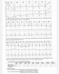 Экстросистолы, тахикардия фото 2