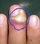 Абсцесс ногтя фото 1