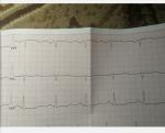Анализ экг фото 2
