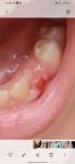 Шишочка после вырывания молочного зуба фото 1