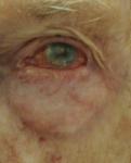 Боль в левом глазу, сильное воспаление фото 1