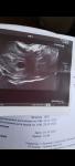 6,5 недель беременности- нет желточного мешочка и эмбриона фото 2