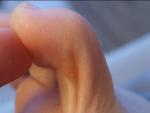 Плотное бесцветное образование на пальце ноги фото 3