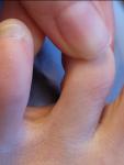 Плотное бесцветное образование на пальце ноги фото 2