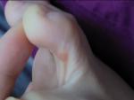 Плотное бесцветное образование на пальце ноги фото 1