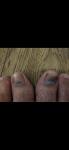 Темные пятна на ногтях ног фото 2