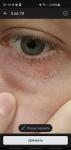 Проблемы кожи под глазом фото 2