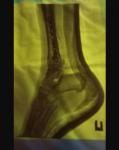 3-лодыжечный перелом ноги закрытый правого голеностопного сустава фото 4