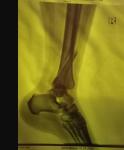3-лодыжечный перелом ноги закрытый правого голеностопного сустава фото 1