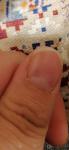 Изменения в ногтевой пластине большого пальца руки фото 1