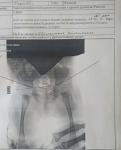 Рентген тазобедренных суставов фото 2