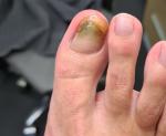 Бактериальная инфекция ногтя фото 1