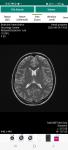 Гипофиз, головной мозг, снимки мрт фото 1