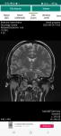 Гипофиз, головной мозг, снимки мрт фото 3