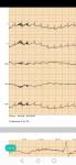 Приступы аритмии фото 3