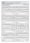 Правильно ли назначено лечение, жду комментарии к результатам холтера фото 3