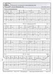 Правильно ли назначено лечение, жду комментарии к результатам холтера фото 2