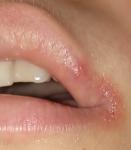 Болят уголки губ, возможно ли, что это герпес? фото 3